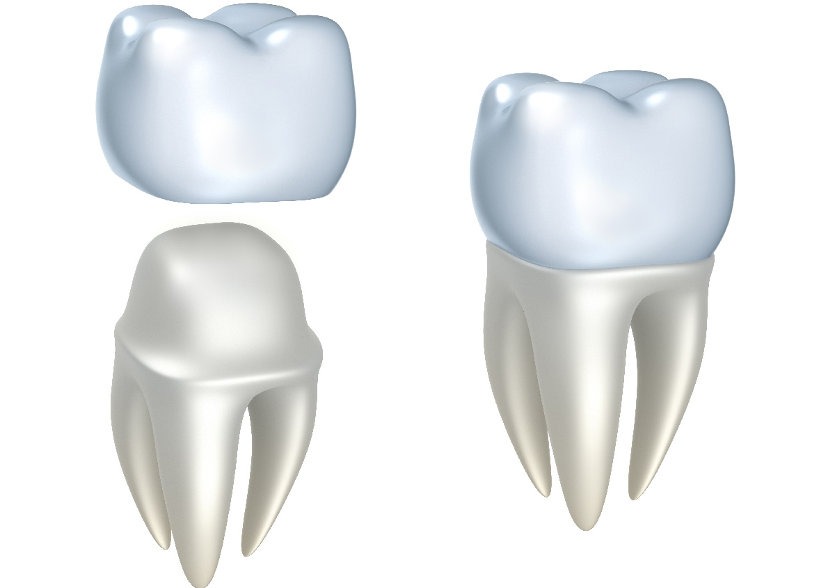 The Best Cosmetic Dental Crown Treatments Near Me In San Marcos, CA