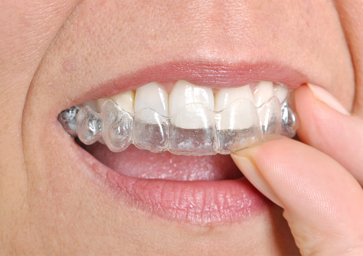 Clear Aligner Therapy in San Marcos California Area