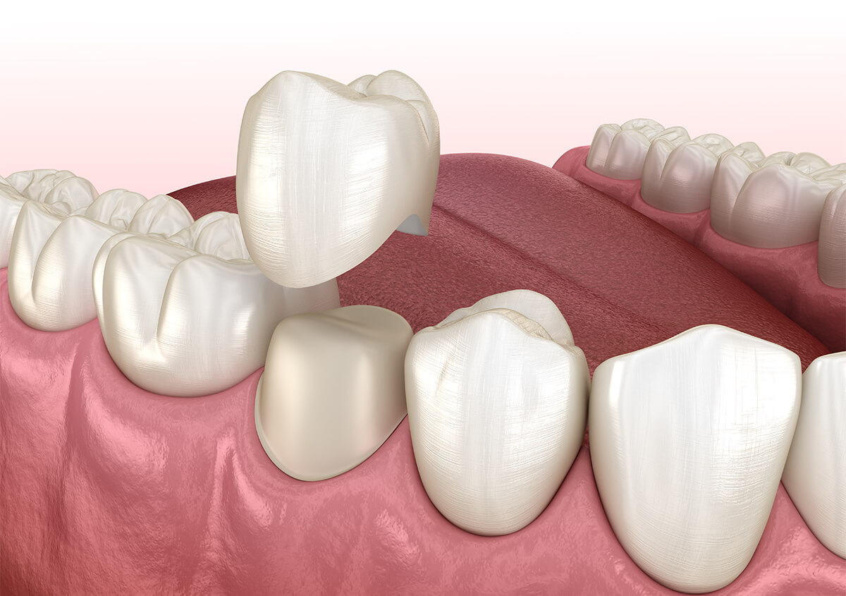 Dental Crowns Treatment in San Marcos CA Area