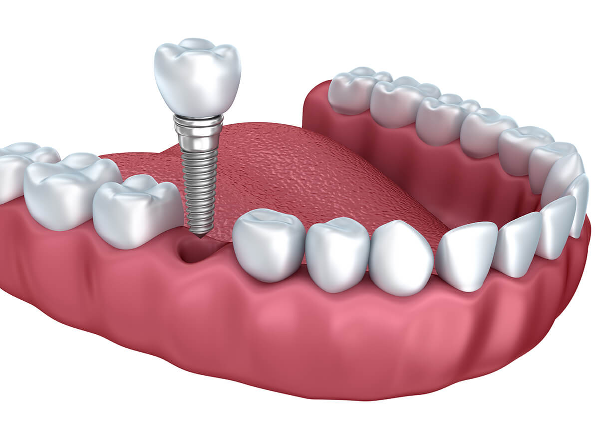 Dental Implant Restoration in San Marcos CA Area