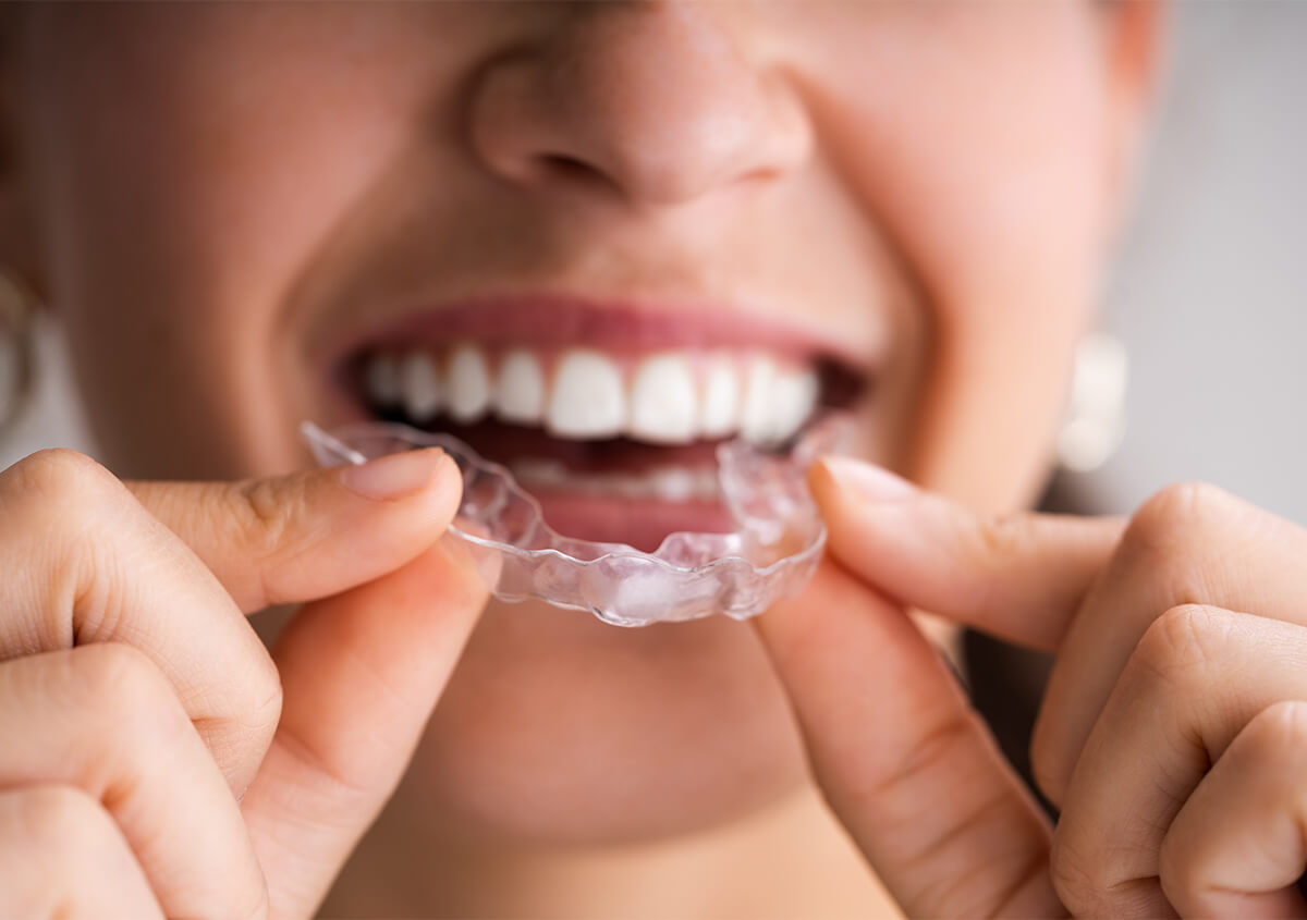 Fix Overbite with Invisalign in San Marcos CA Area