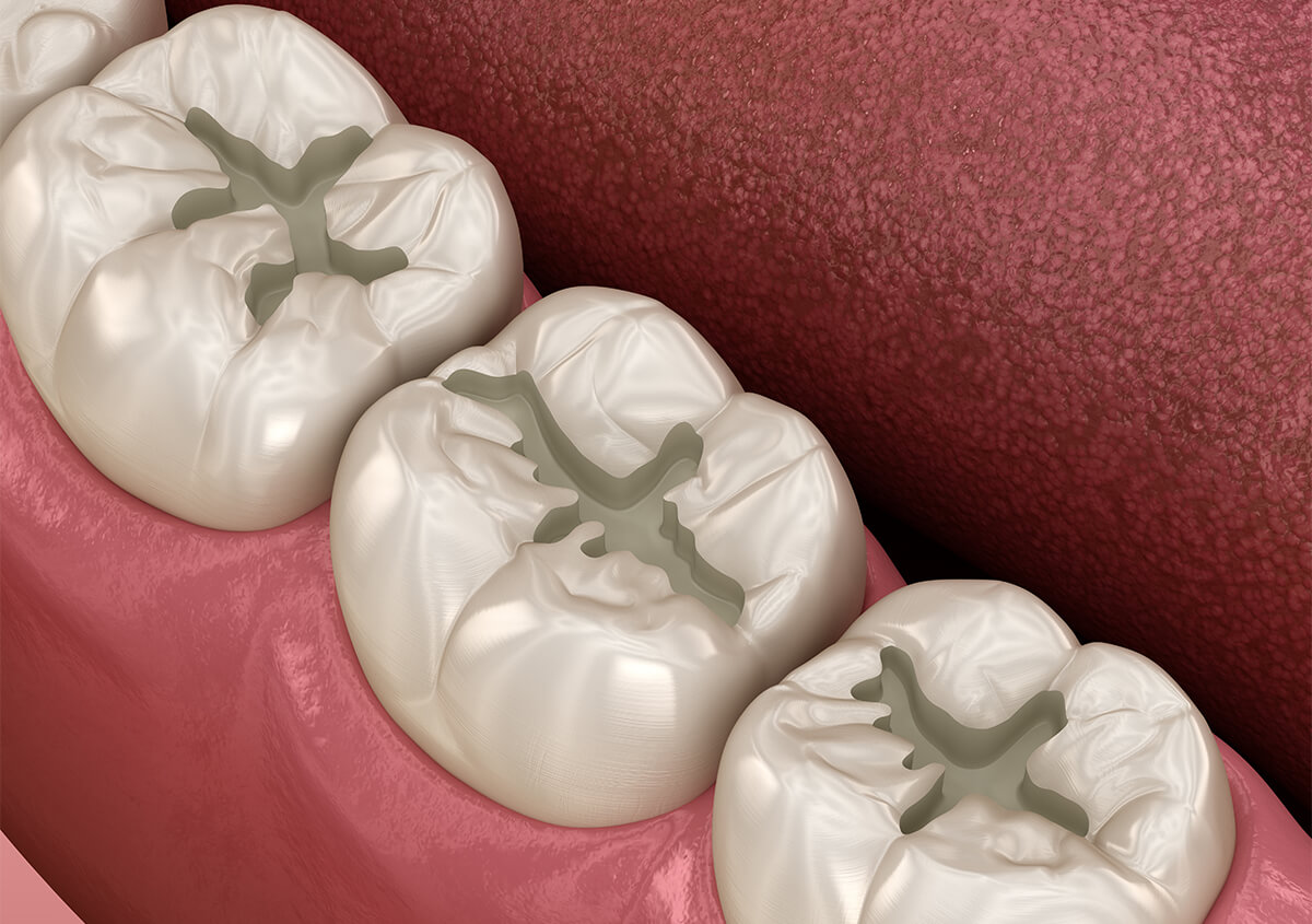 How Long do Composite Fillings Last in San Marcos CA Area