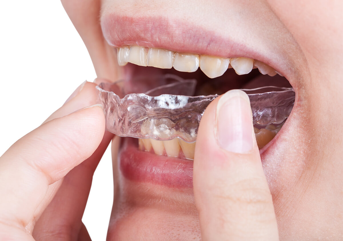 Invisalign System in San Marcos CA Area
