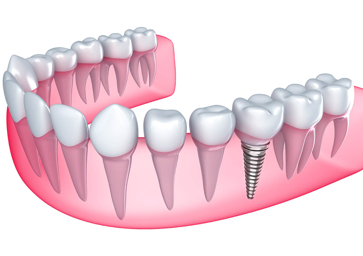 https://www.shadowridgedentists.com/teeth-implants-san-marcosca/
